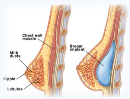 Implanty piersi